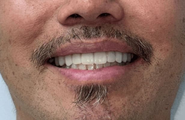 5 After | Family dentist Artarmon