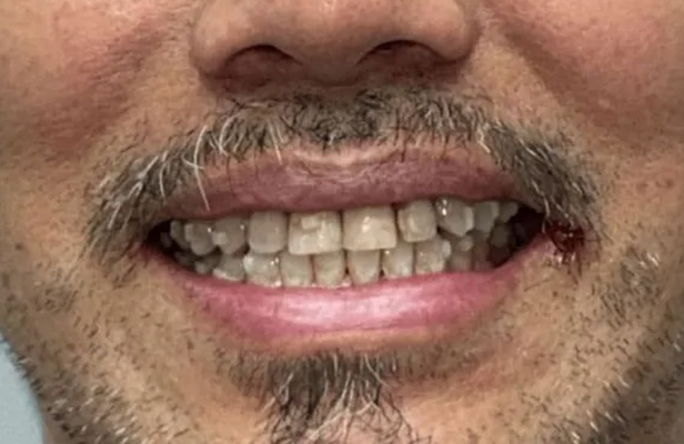 5 Before |Family dentist Artarmon